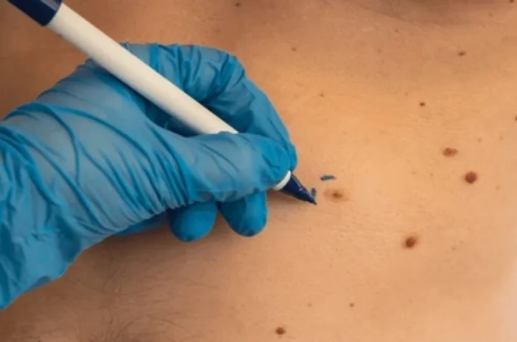 Removal of Skin Tags, Warts, Corns